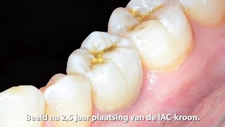 Extractie onmiddellijke plaatsing en restauratie van een eerste molaar in de onderkaak met een IAC [upl. by Stargell]