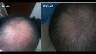 Regenerador Capilar Rc Funciona  Tratamiento para la alopecia  Cómo recuperar mi cabello [upl. by Neelasor196]