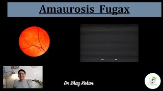 Amaurosis Fugax What is it What Causes it Will I go Blind How is it Treated I Dr Rehan 2021 [upl. by Bittencourt36]