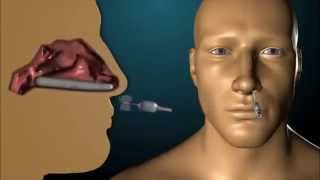 Rapid Rhino Epistaxis Device [upl. by Peregrine303]