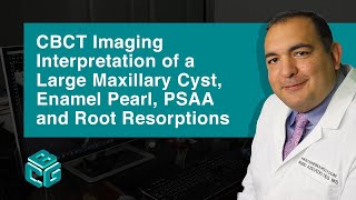 CBCT Imaging Interpretation of a Large Maxillary Cyst Enamel Pearl PSAA and Root Resorptions [upl. by Pickett]