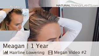 Female Hairline Lowering Hair Transplant 1 Year After  Dr Matt Huebner Meagan [upl. by Eduard]