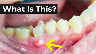 What is an Abscessed Tooth amp What To Do About It [upl. by Autumn731]