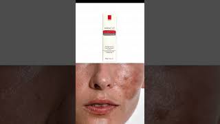 Melasma Treatment in urduMiracle Creamhyperpigmenttation cream benefits in urdu [upl. by Ardnosak386]