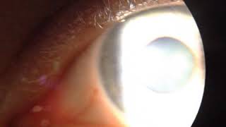 Bilateral tonic pupils vermiform pupil movement [upl. by Alvis]