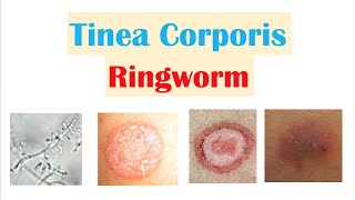 Ringworm Tinea Corporis  Causes Risk Factors Signs amp Symptoms Diagnosis and Treatment [upl. by Beisel]