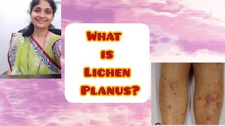 Lichen Planus  Skin conditions  Treatment of Lichen Planus  Homeopathy  Health [upl. by Cynara832]