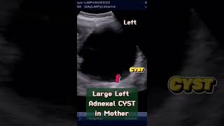 Large Ovarian Cyst in Mother with Normal Pregnancy of 33 wks ultrasound pregnancy baby [upl. by Chien]