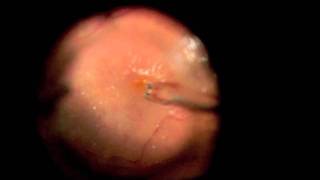 Epiretinal Membrane Peeling [upl. by Freddie]