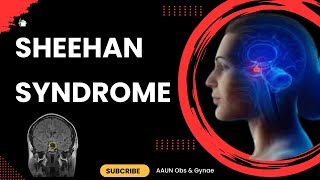 Sheehan Syndrome  Causes Symptoms Diagnosis Treatment and Pathophysiology [upl. by Yoj]