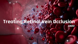 Treating Retinal Vein Occlusion RVO [upl. by Meri]