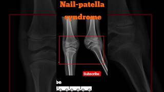 Nailpatella syndrome  Knee xray shorts radiology kneedisease [upl. by Horwitz]