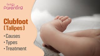 Club Foot Talipes in Babies  Causes Signs amp Treatment [upl. by Kristie]