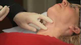 Laryngeal Botox Injection  Dr Ekbom at Mayo Clinic [upl. by Haskel]