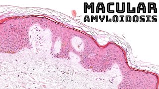 Macular amyloidosis cutaneous keratin derived amyloid pathology dermpath dermatology [upl. by Atnuhs]