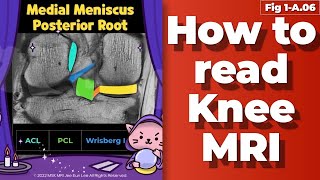 Fig 1A06 Medial Meniscus Posterior Root Anatomy degeneration tear [upl. by Petronia]