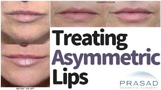 How to Treat Asymmetric Lips and Smiles [upl. by Giardap772]