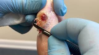 Callus Debridement With Hidden Abscess [upl. by Ailhad]