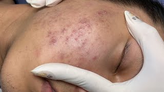 ACNE TREATMENT VU QUYNH MI Acne On Boys Chin 2024 [upl. by Ariam]