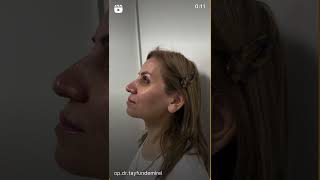 big nose rhinoplasty nosejobbeforeandafter nosejobs rhinoplasty [upl. by Yarled]