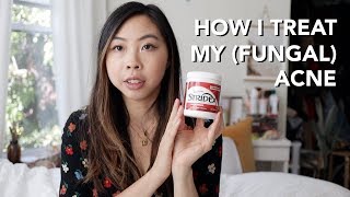 HOW I TREAT MY ACNE amp FUNGAL ACNE [upl. by Okramed723]