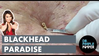 Blackhead Paradise [upl. by Goldfarb]