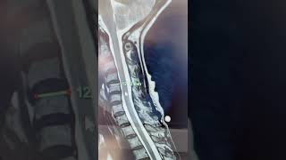 Two Cervical Surgeries Anterior and Posterior [upl. by Rodavlas]