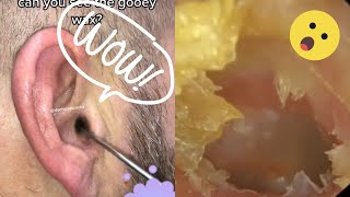 Ultimate Ear Cleaning Compilation Witness the Most Gratifying Removals [upl. by Becka]