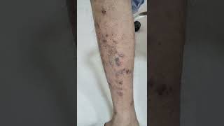 PRURIGO NODULARIS PN skincare dermatology disease healing viralvideo shorts disease [upl. by Caresse151]