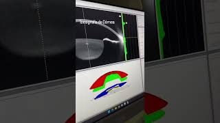 Topografia de Córnea [upl. by Kerin]
