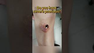 Do you have severe psoriasis psoriasis [upl. by Ajan]