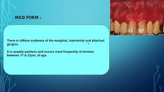 Desquamative Gingivitis [upl. by Lucchesi]