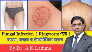 Ringworm Fungal Infection Complete information [upl. by Ximena]