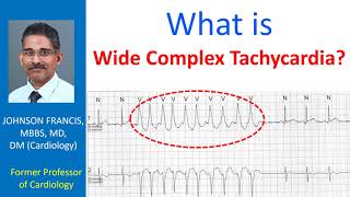 What is Wide Complex Tachycardia [upl. by Dorolice]