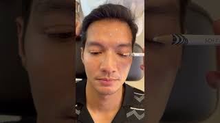 Botox for Men Brotox botox botoxinjections botoxfillers [upl. by Enilemme]