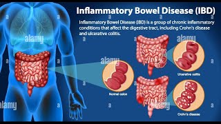 Understanding Inflammatory Bowel Disease IBD A group of intestinal disorders trending ibd [upl. by Allehs786]