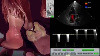 HeartWorks Aortic Stenosis with Doppler [upl. by Byrle641]