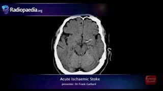 Stroke Acute infarction  radiology video tutorial CT MRI angiography [upl. by Ahsatin167]