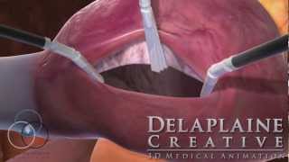 Robotic Atrial Septal Defect Repair [upl. by Katleen135]