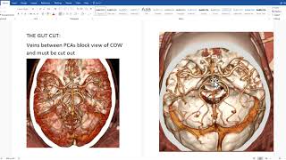 How to make COW reconstructions of CTA head exams using TeraRecon video 1 of 3 [upl. by Iahk164]