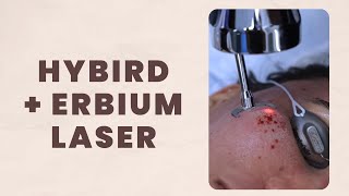 I WANT BABY SMOOTH SKIN WITHOUT ACNE SCARS  HYBIRD  ERBIUM LASER  PATIENT STORY  Dr Jason Emer [upl. by Airres208]