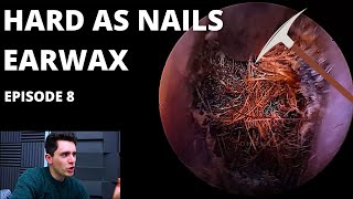 Hard As Nails Ear Wax EPISODE 8 [upl. by Aerda]