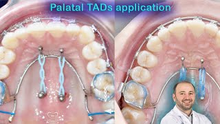 Wide range of palatal TADs applications mini screws palatelly benefits of mini implants in palate [upl. by Nna]