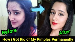 How to Remove Pimples Acne Pimple Marks completely  ThatGlamGirl [upl. by Novyar490]