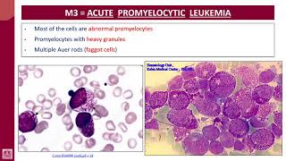 Hematology  2  U2L24  FAB classification of AML subtypes  3 [upl. by Peterson]