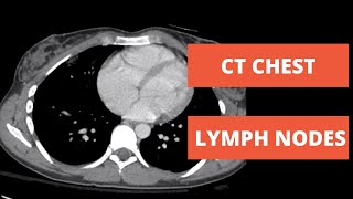 Lymph Nodes Stations of the Chest on CT [upl. by Euqinom87]