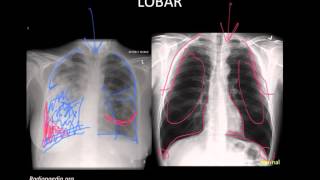 Pneumonia Imaging [upl. by Drawd]