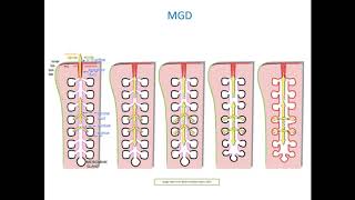 Online Seminar Sruthi Srinivasan Evaluating MGD and Meibography with the Keratograph® 5M [upl. by Asilenna949]