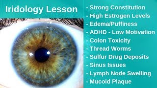 Iridology Lesson  Parasites and Mucoid Plaque [upl. by Gabler]