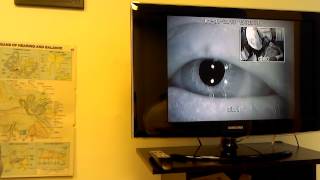 Eye Video Downbeat Nystagmus [upl. by Camala384]